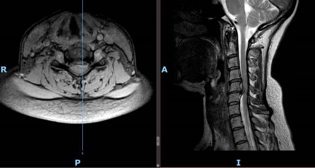 Mielopatía cervical Barcelona Spine Institute BSI