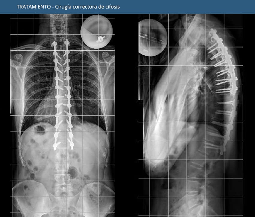 Kyphosis - Treatment - Surgery