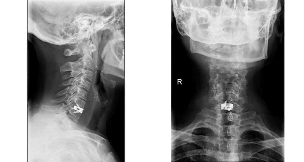 Cervical myelopathy