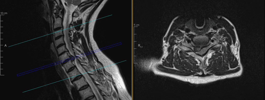 Cervical myelopathy