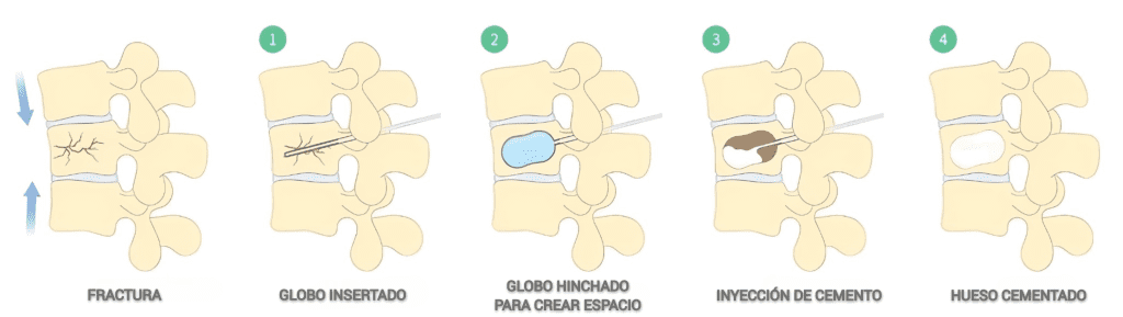 VERTEBROPLASTIA-CIFOPLASTIA