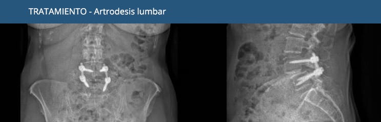 Artrodesis lumbar