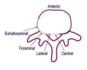 Hèrnia discal cervical