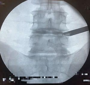 Cirurgia endoscòpica de columna