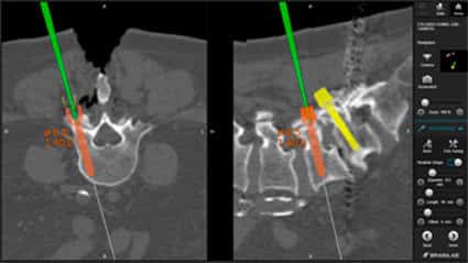 Cirurgia guiada amb navegació