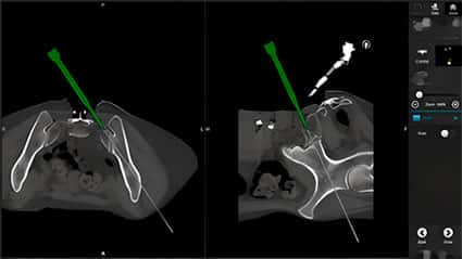 Cirurgia guiada amb navegació